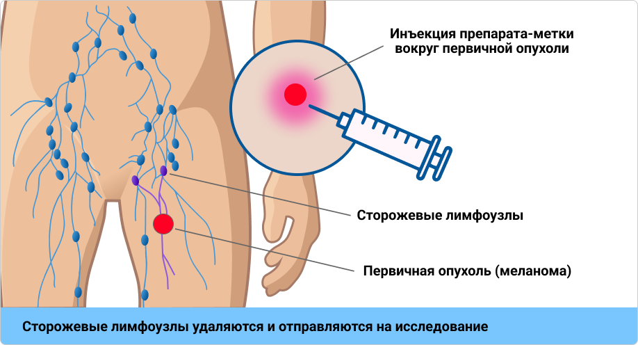 Методика проведения БСЛУ.